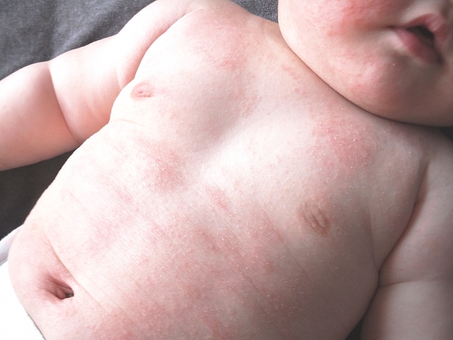 乳児湿疹とは？